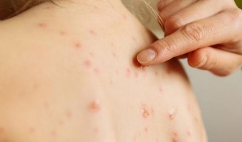 LA SECRETARA DE SALUD RECUERDA A LA COMUNIDAD LA IMPORTANCIA DE LA VACUNACIN CONTRA EL SARAMPIN